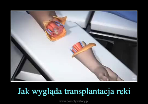 Jak wygląda transplantacja ręki –  