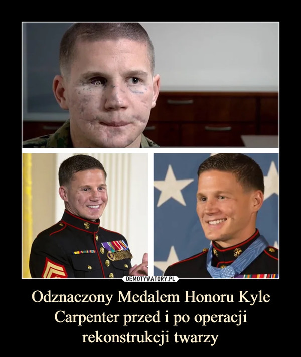 Odznaczony Medalem Honoru Kyle Carpenter przed i po operacji rekonstrukcji twarzy –  