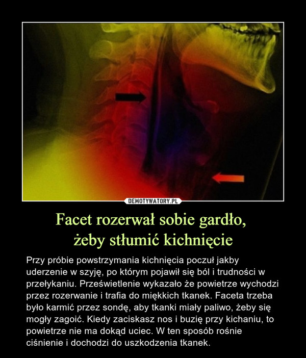 Facet rozerwał sobie gardło, żeby stłumić kichnięcie – Przy próbie powstrzymania kichnięcia poczuł jakby uderzenie w szyję, po którym pojawił się ból i trudności w przełykaniu. Prześwietlenie wykazało że powietrze wychodzi przez rozerwanie i trafia do miękkich tkanek. Faceta trzeba było karmić przez sondę, aby tkanki miały paliwo, żeby się mogły zagoić. Kiedy zaciskasz nos i buzię przy kichaniu, to powietrze nie ma dokąd uciec. W ten sposób rośnie ciśnienie i dochodzi do uszkodzenia tkanek. 